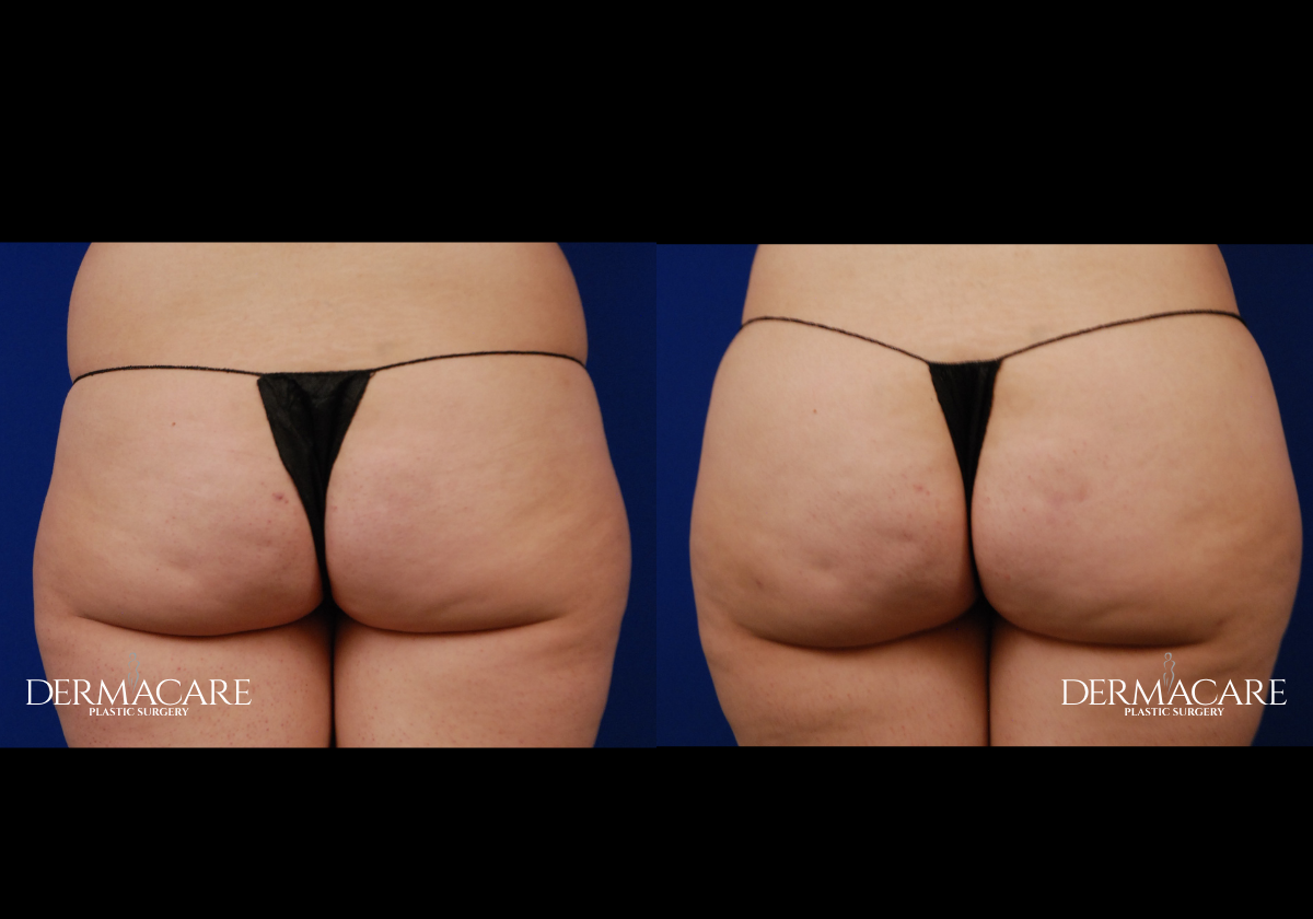 Brazilian Butt Lift Before & After