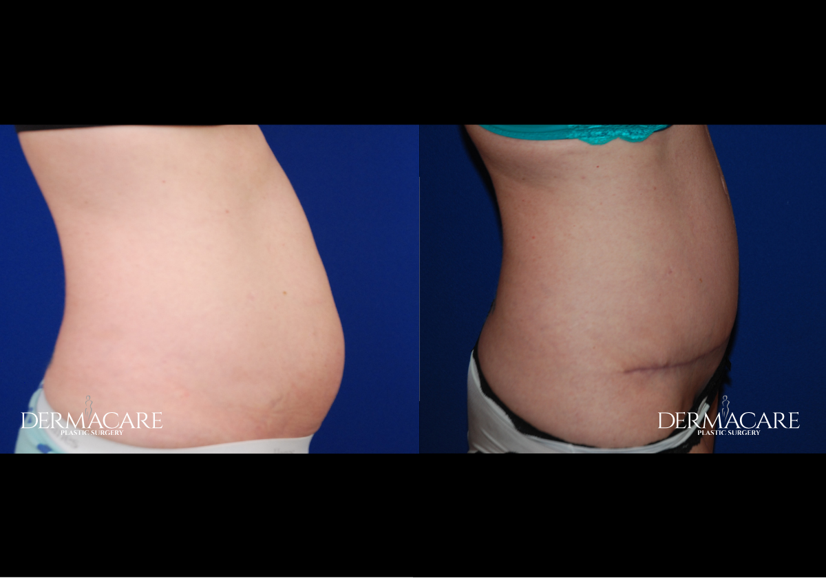 Tummy Tuck before after