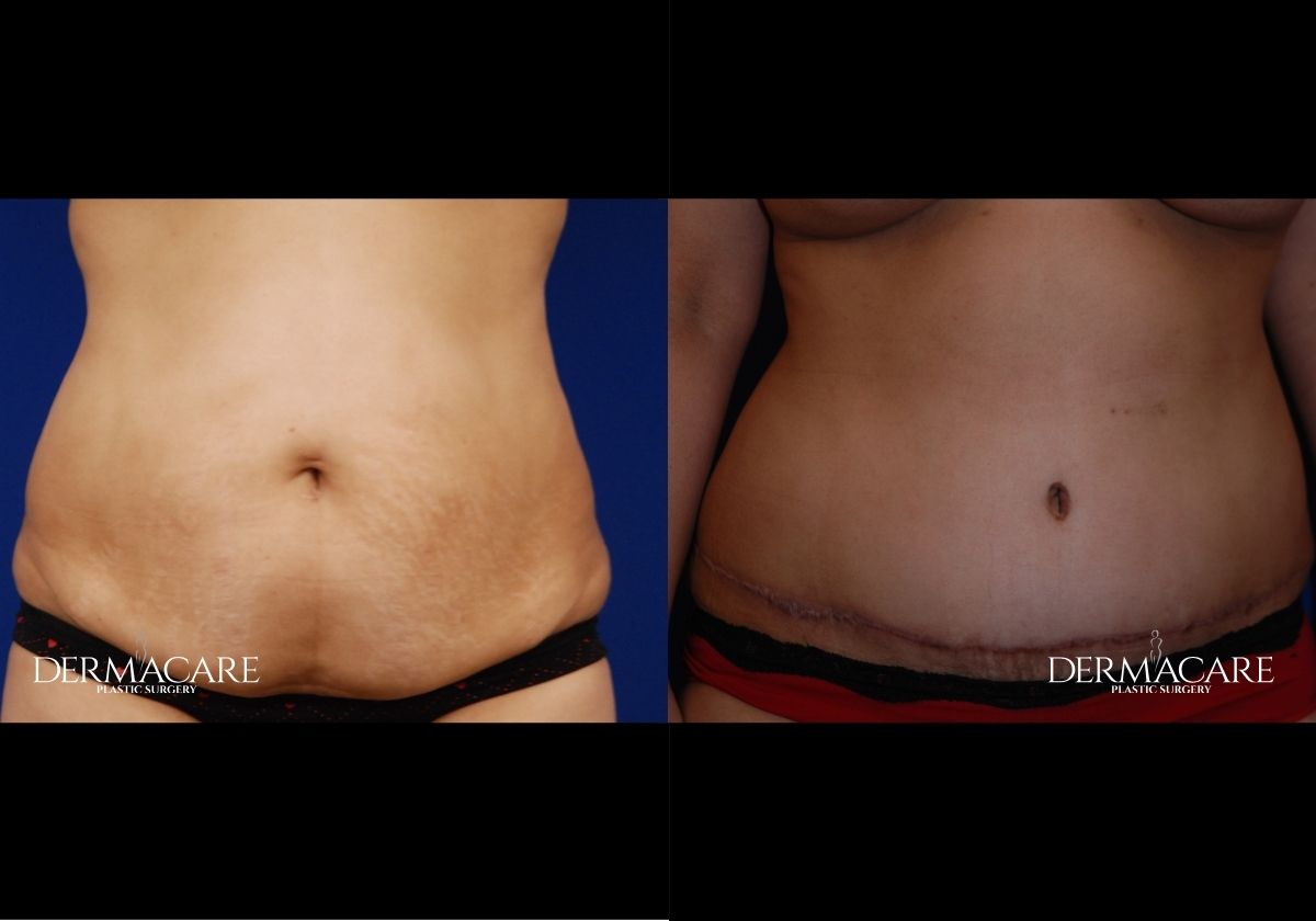Tummy Tuck before after
