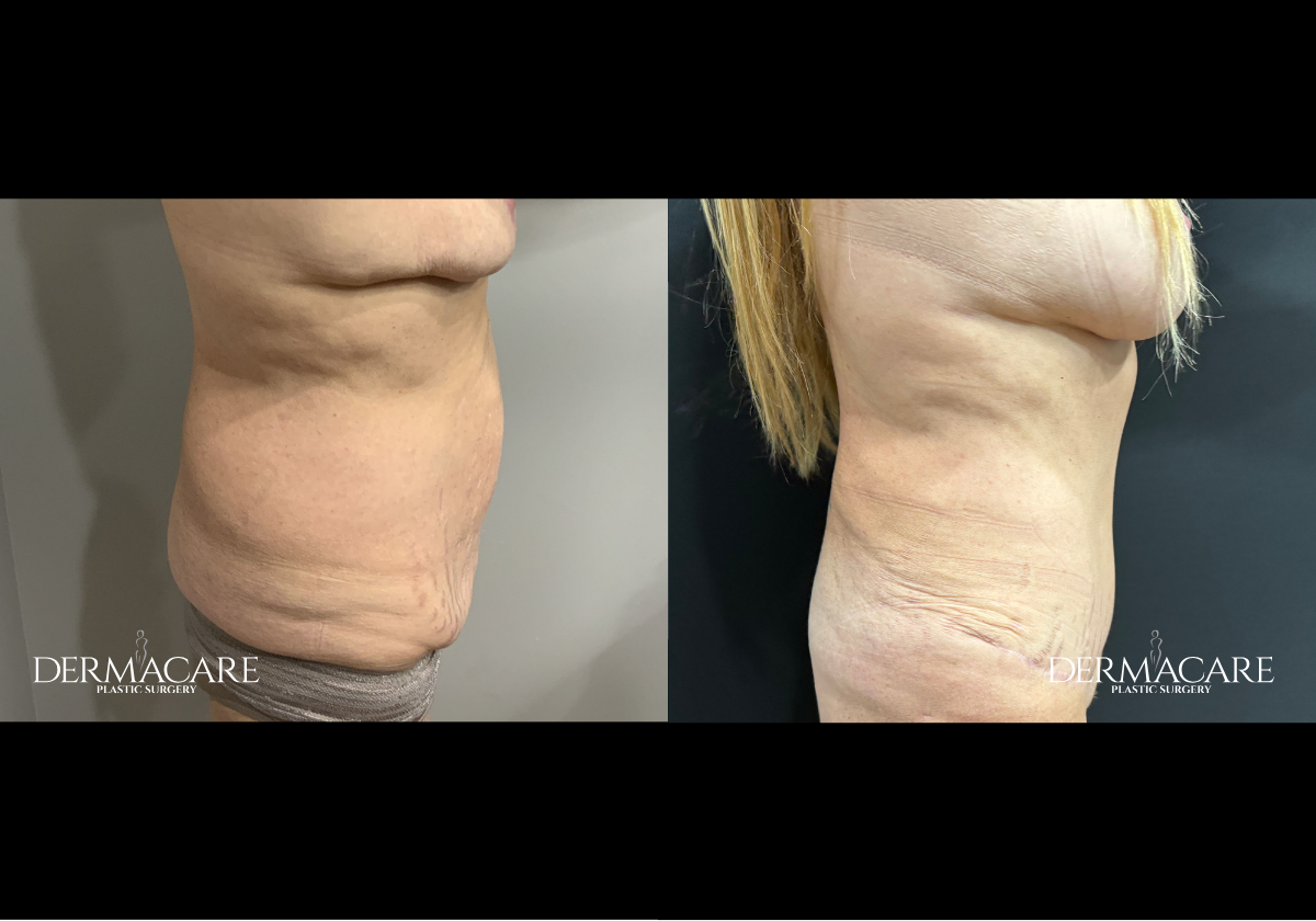 tummy tuck before after
