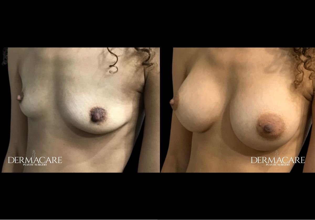 Breast Augmentation