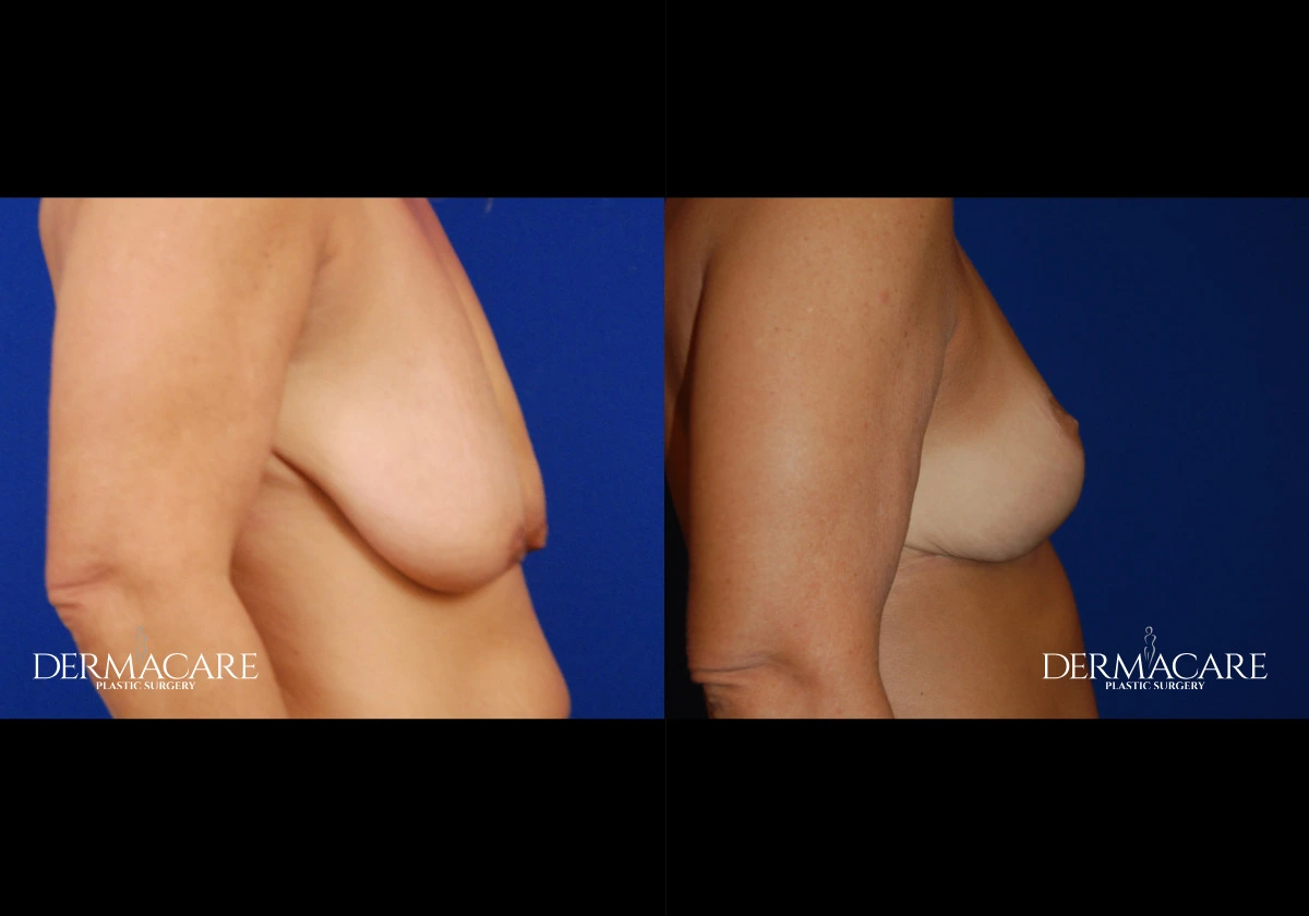 breastlift before after
