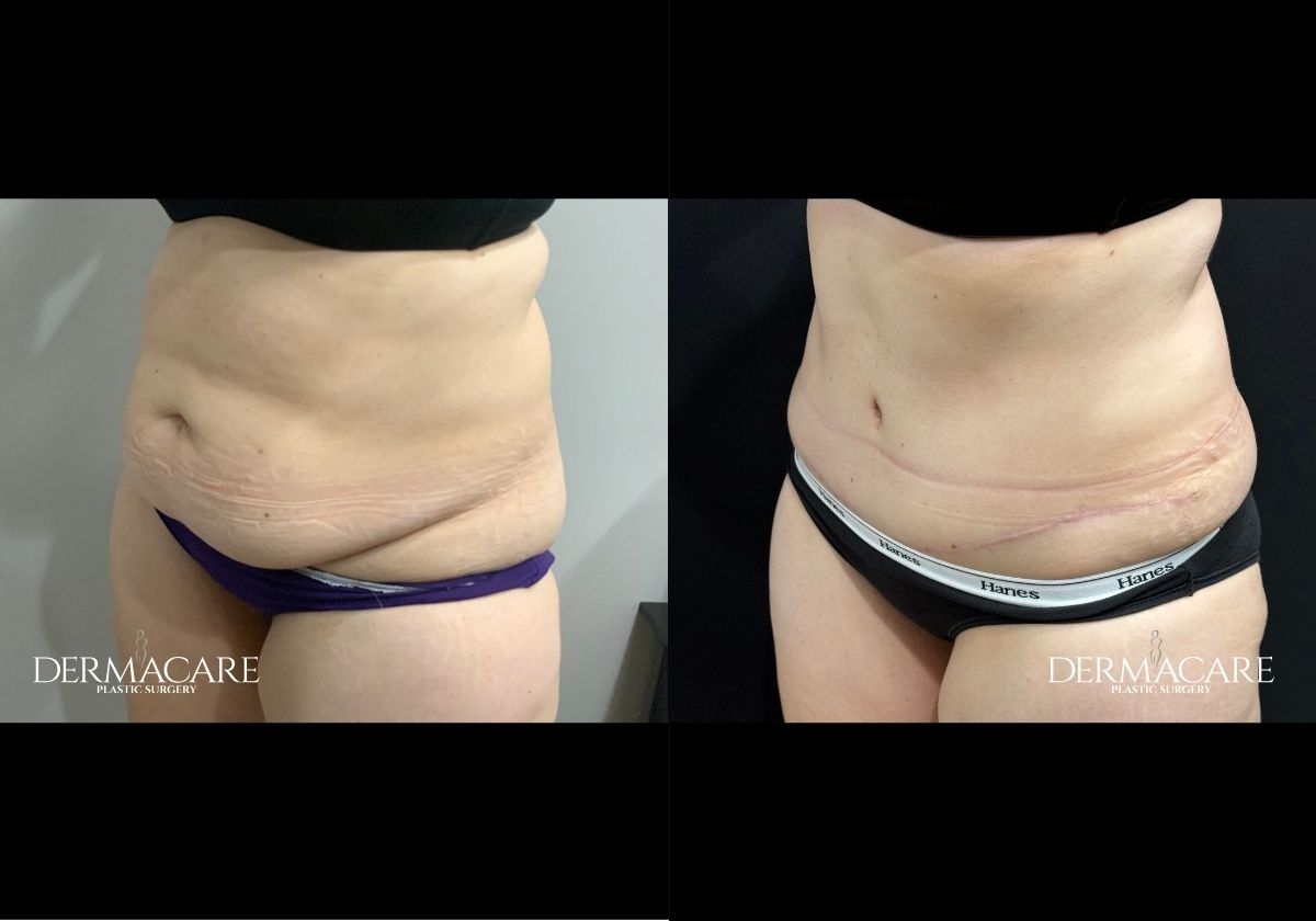 tummy tuck before after