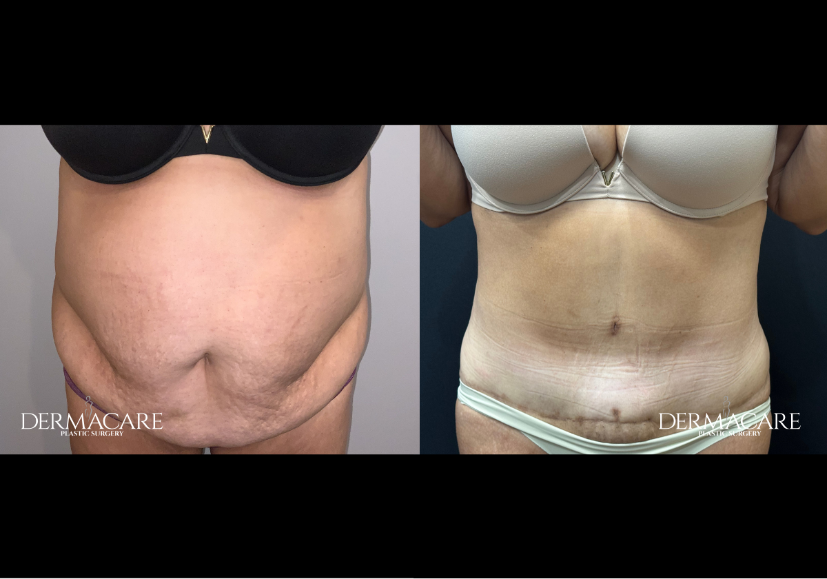tummy tuck before after
