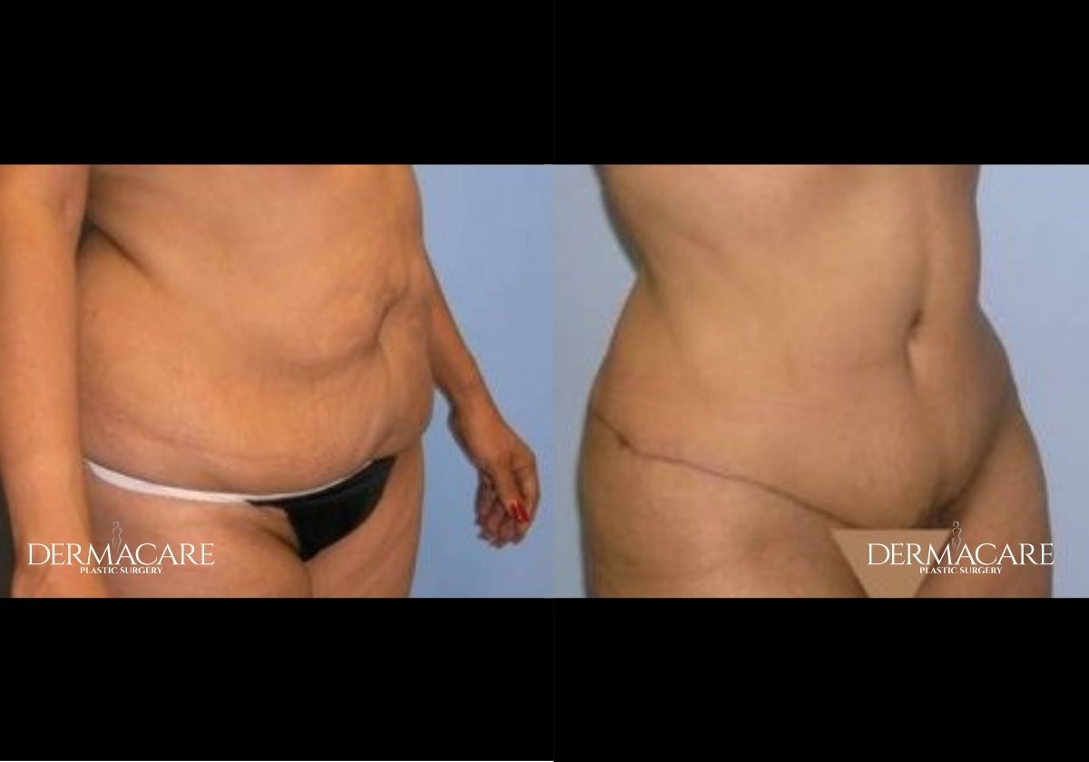 Tummy Tuck-before-after