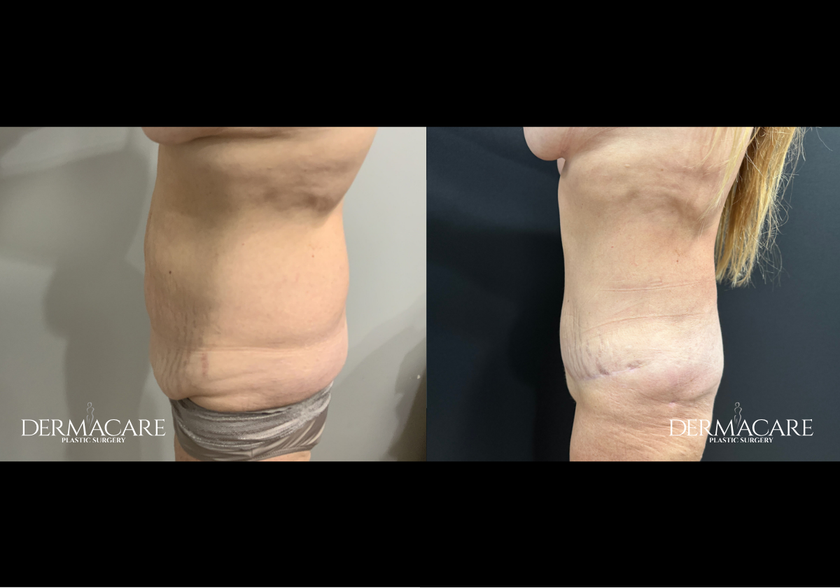 tummy tuck before after