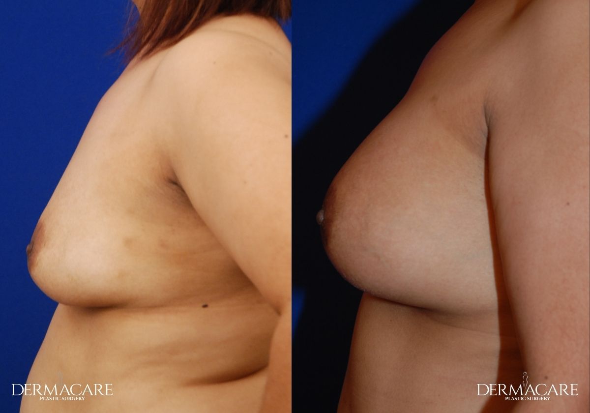 Breast Augmentation