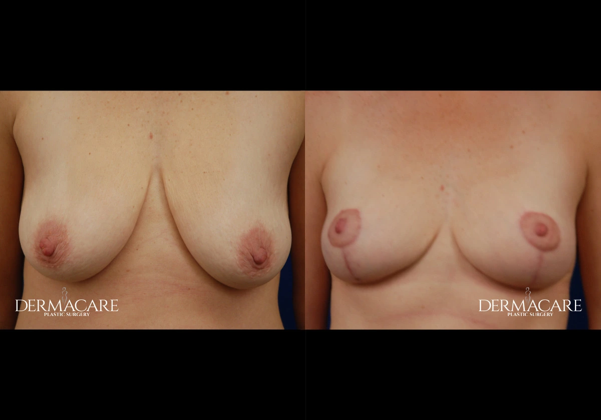breastlift before after