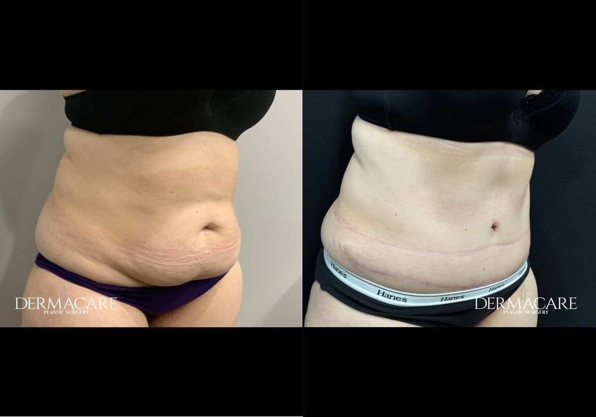 tummy tuck before after