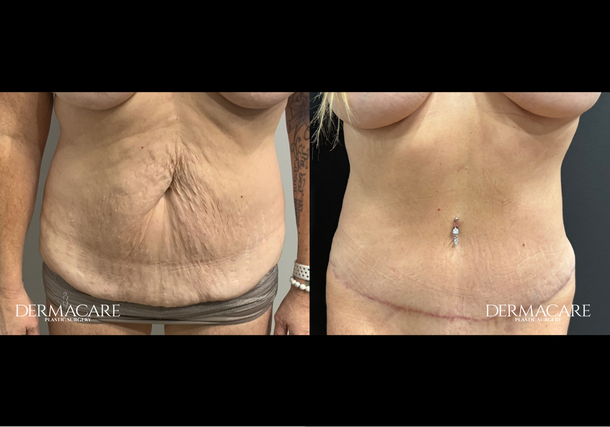 tummy tuck before after