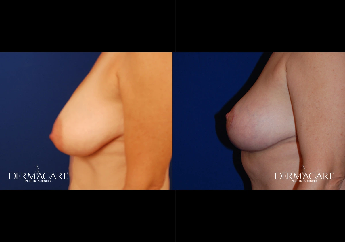 breastlift before after