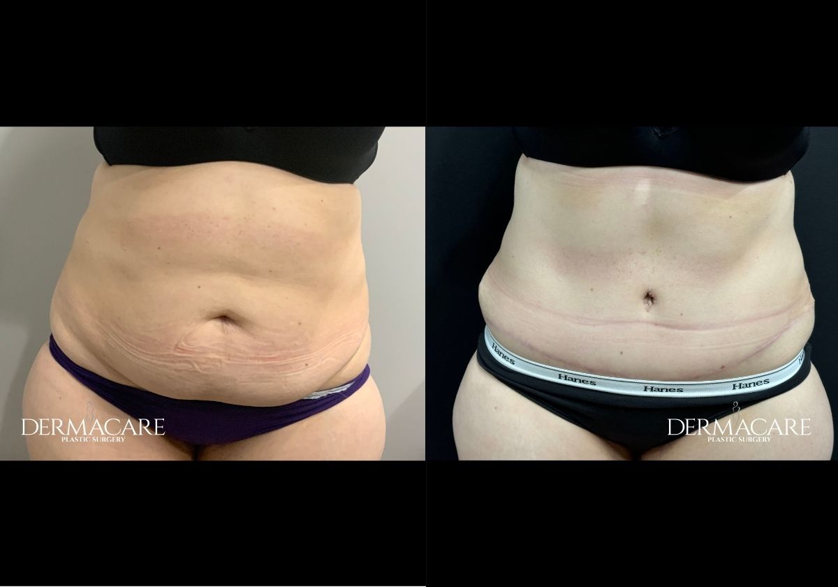 tummy tuck before after