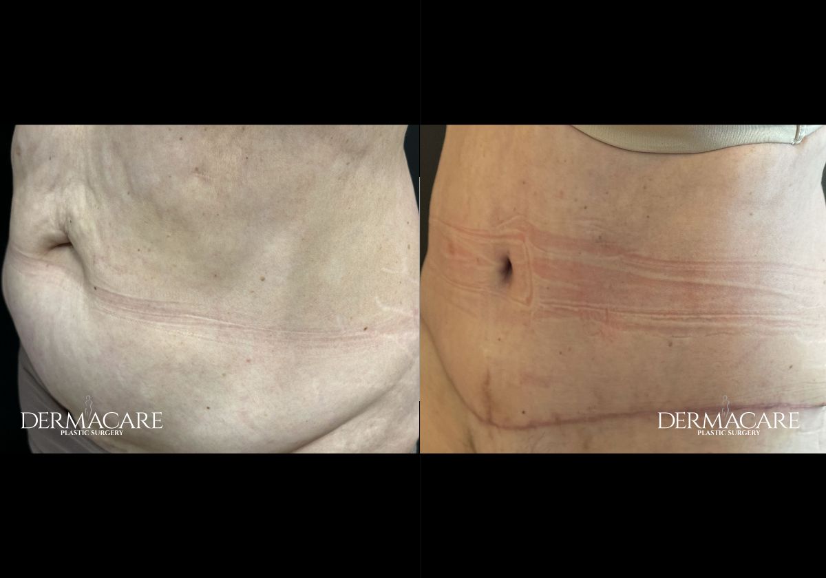 tummy tuck before after
