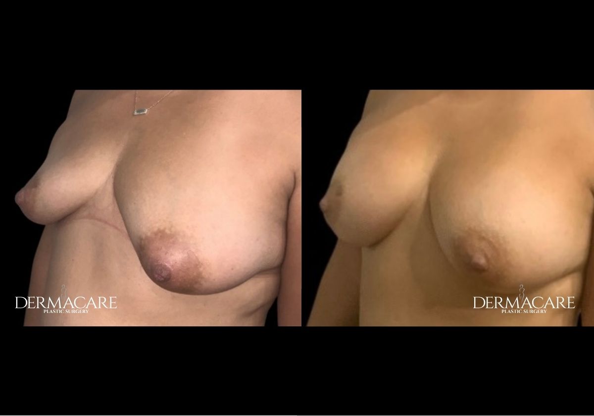 Breast-Augmentation