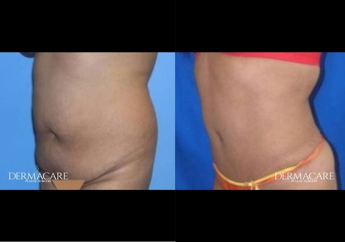 Tummy Tuck Before & Afters