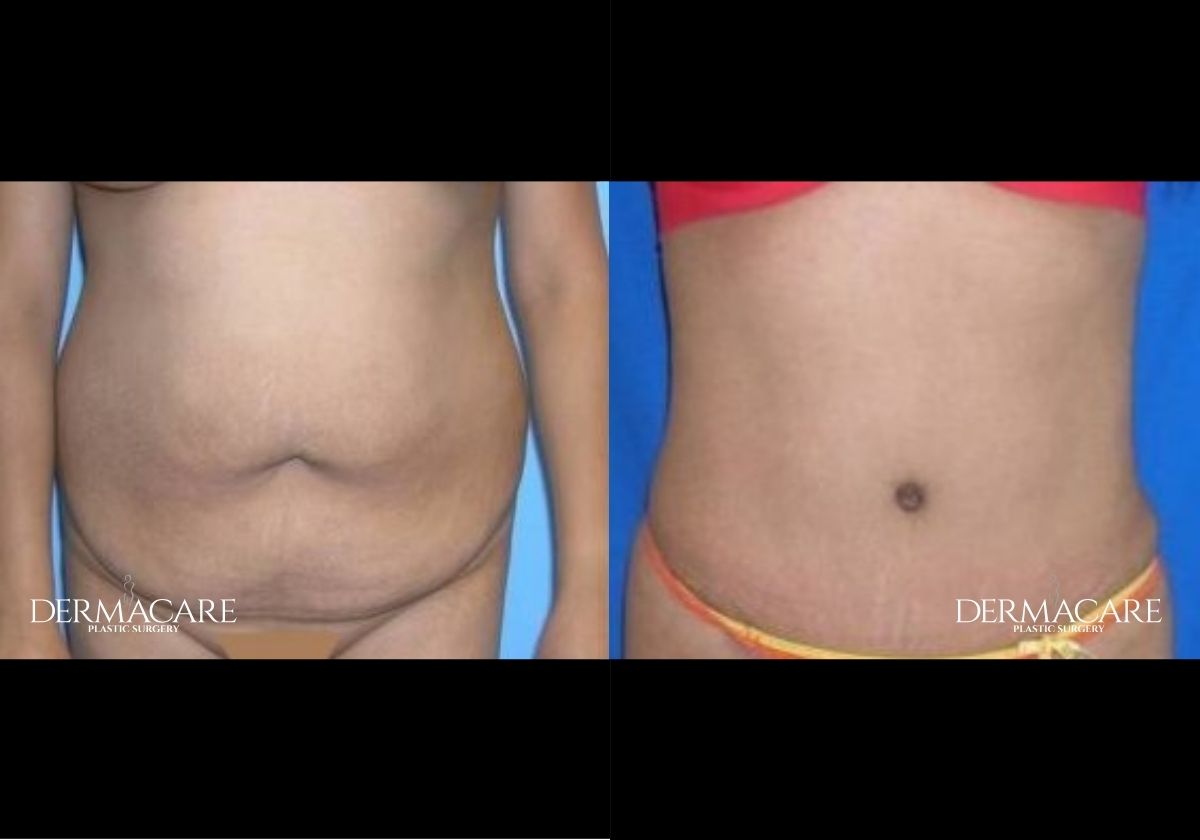 Tummy Tuck Before & Afters