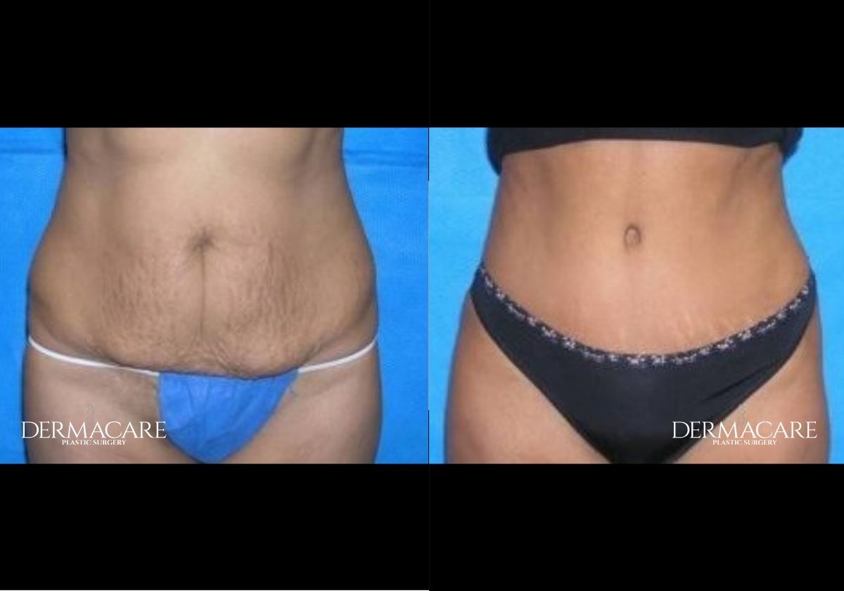Tummy Tuck before-after