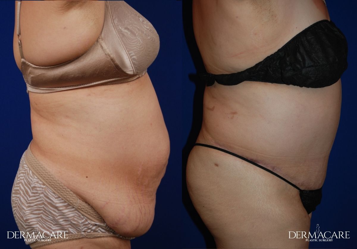 tummy tuck before after