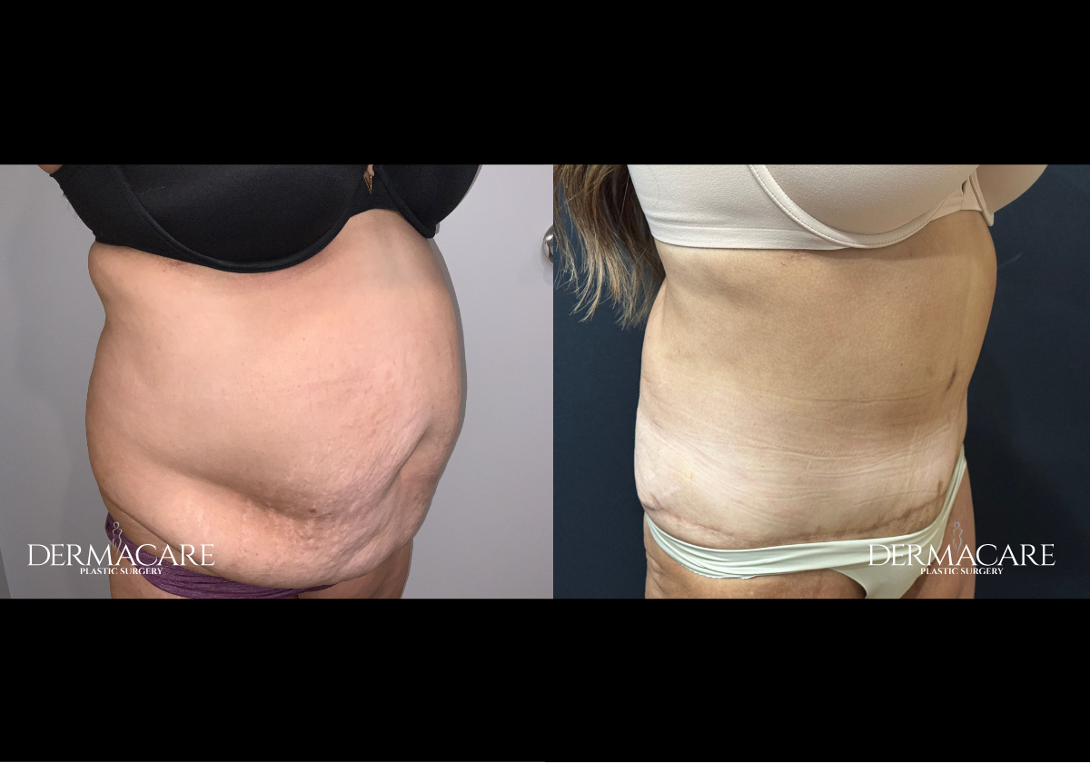 tummy tuck before after