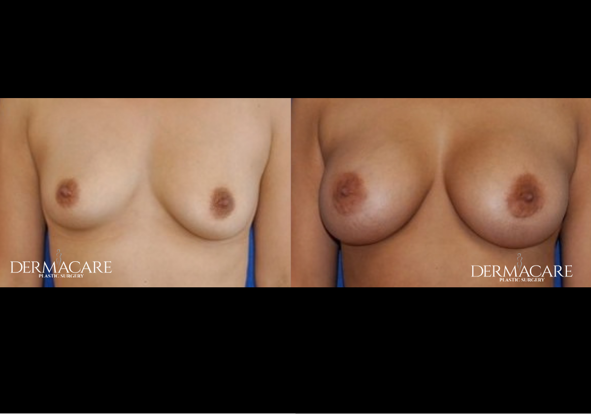 Breast Augmentation Before & Afters