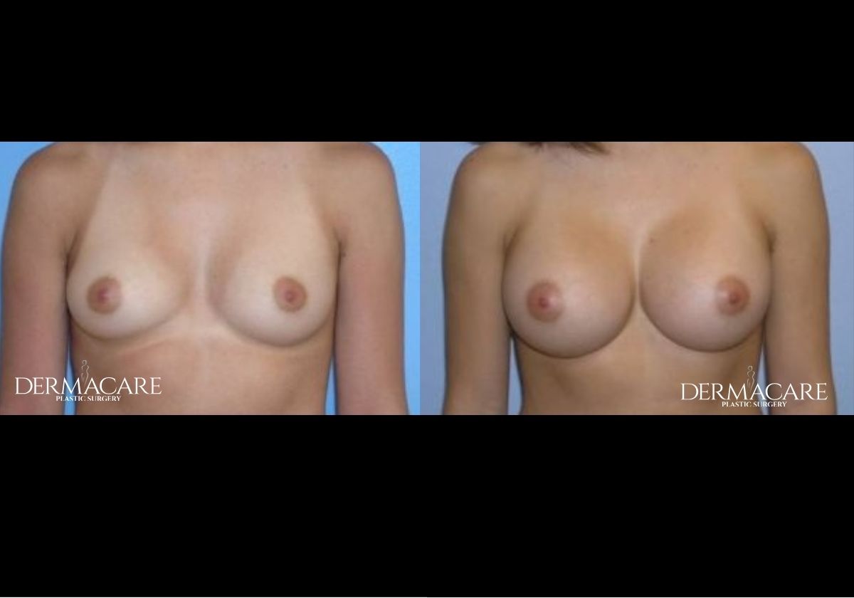 Breast Augmentation Before After
