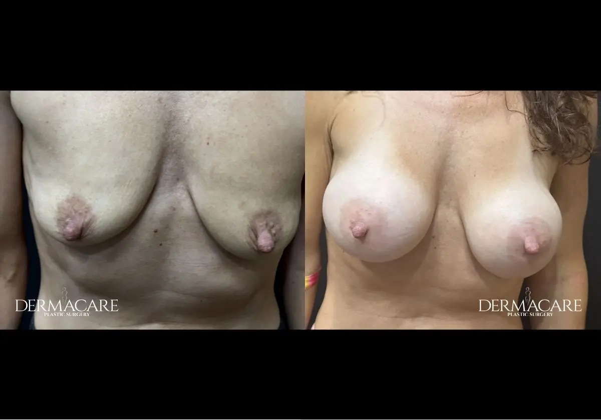 Breast Augmentation Before After