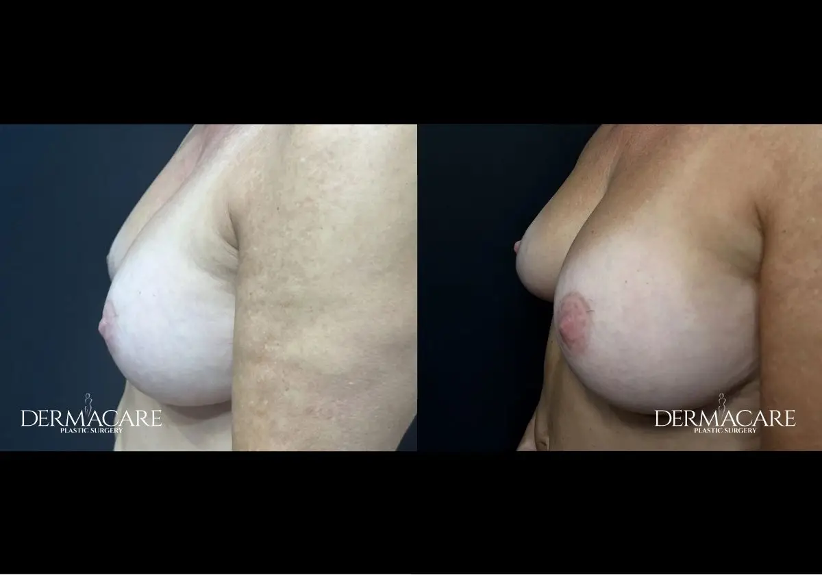 Breast Augmentation Before After