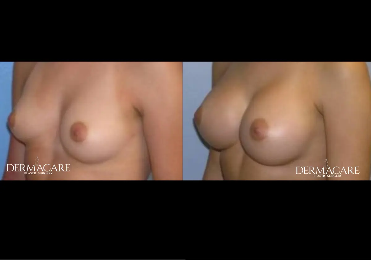 Breast Augmentation Before After