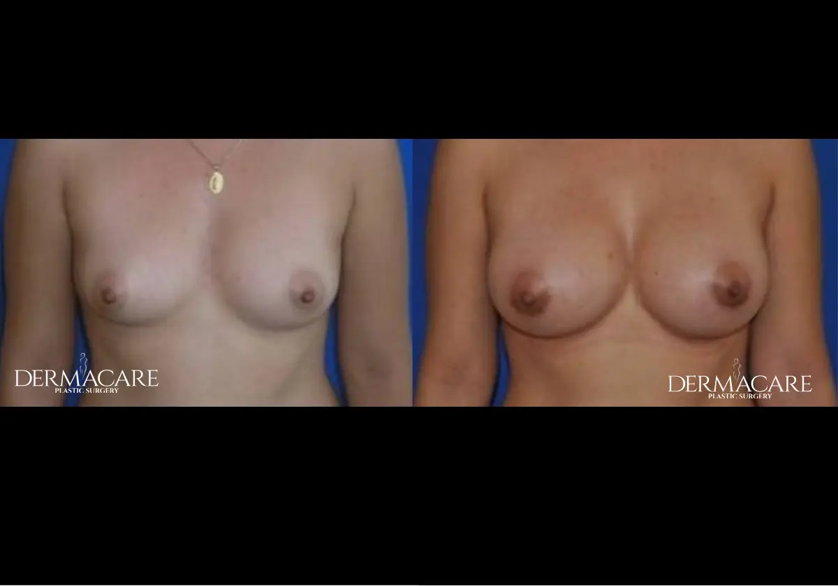 Breast Augmentation Before After