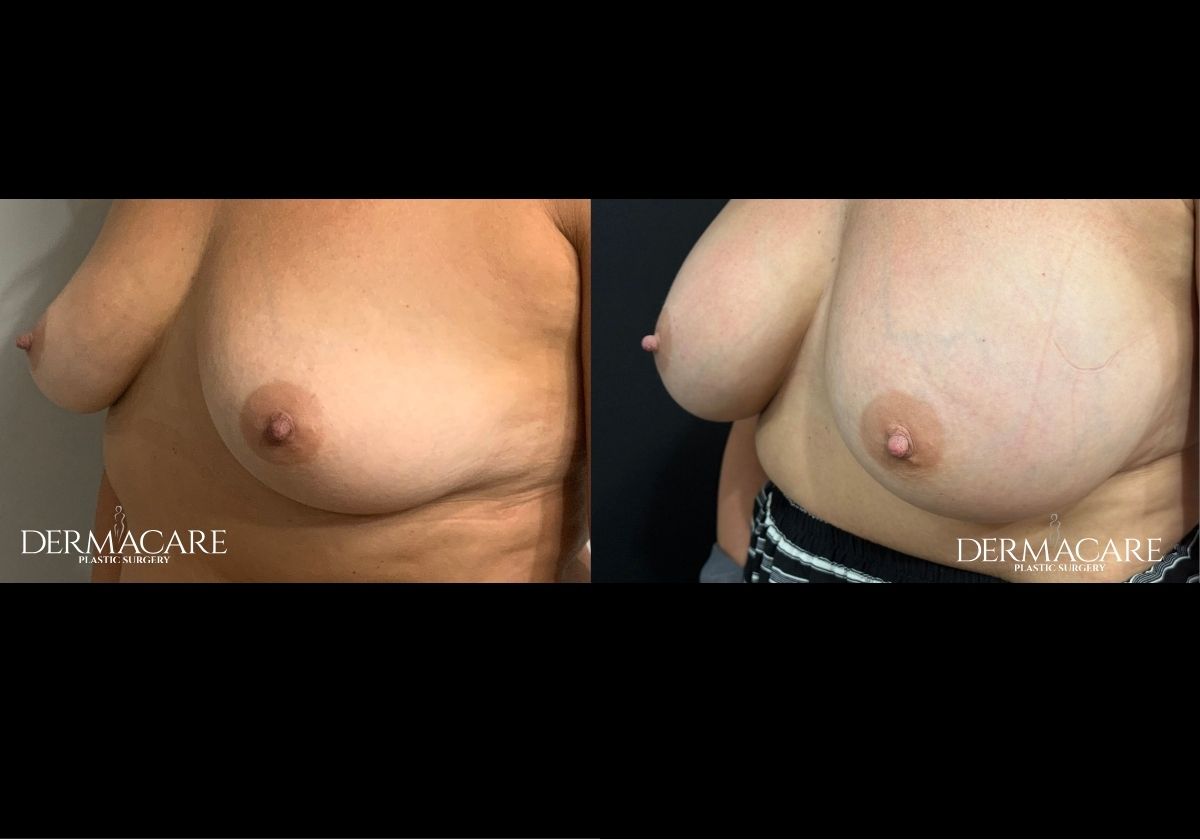 Breast Augmentation Before After