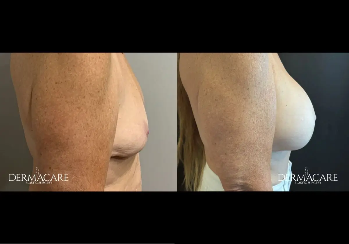 Breast Augmentation Before After