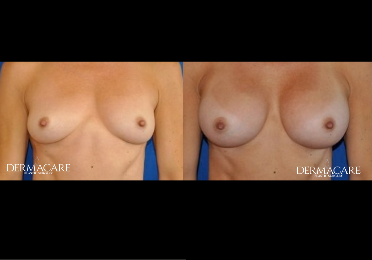 Breast Augmentation Before & Afters