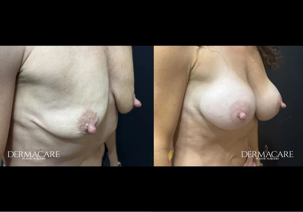 Breast Augmentation Before After