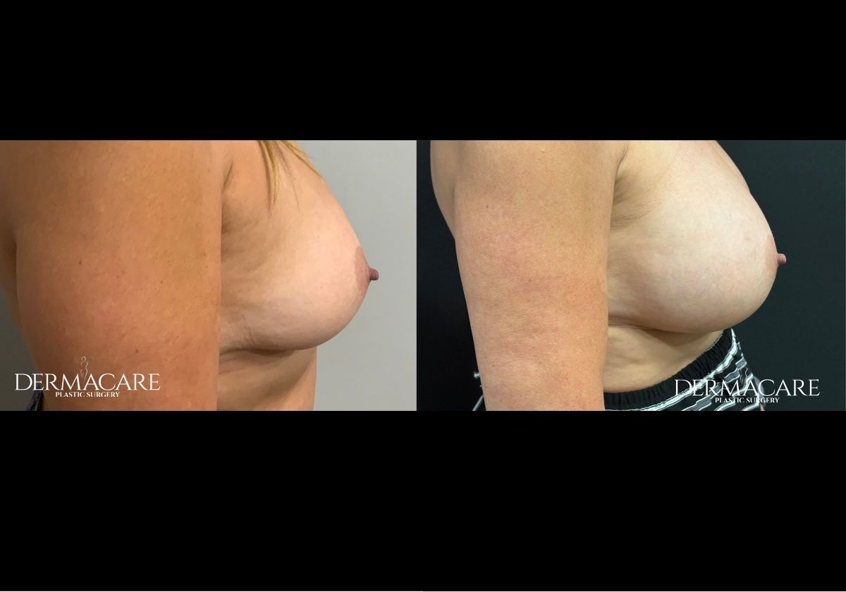 Breast Augmentation Before After