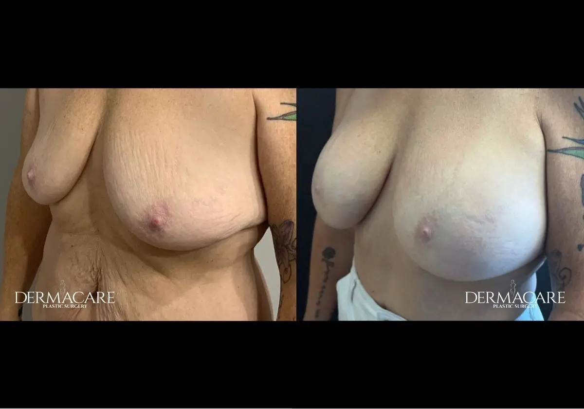 Breast Augmentation Before After
