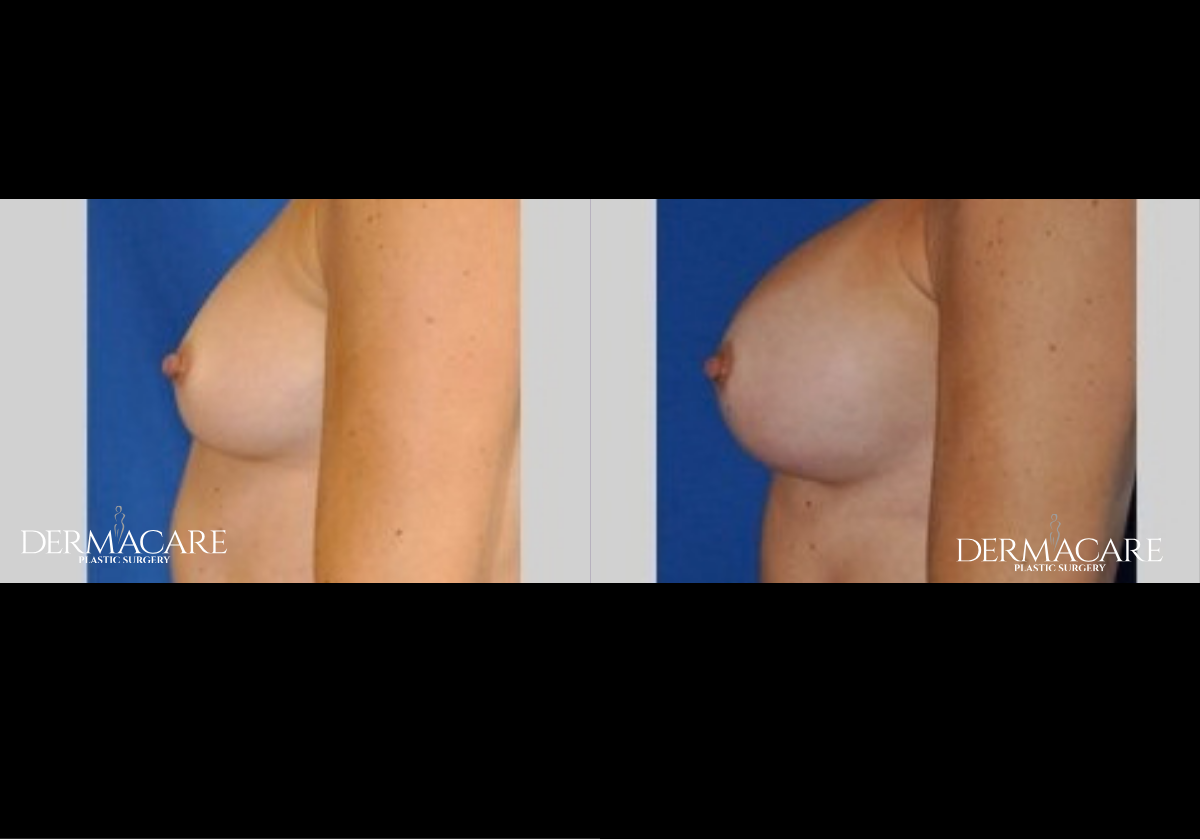 Breast Augmentation Before & Afters