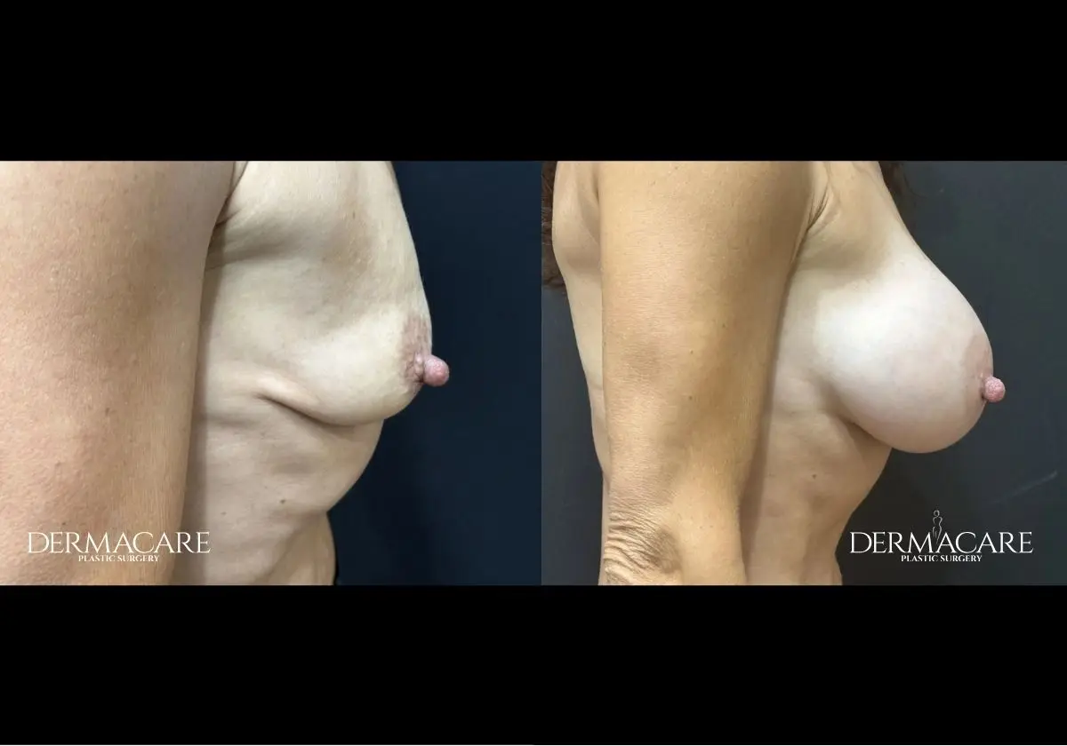 Breast Augmentation Before After