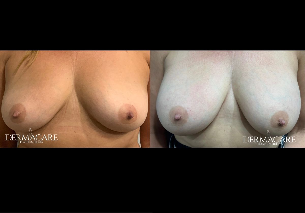 Breast Augmentation Before After
