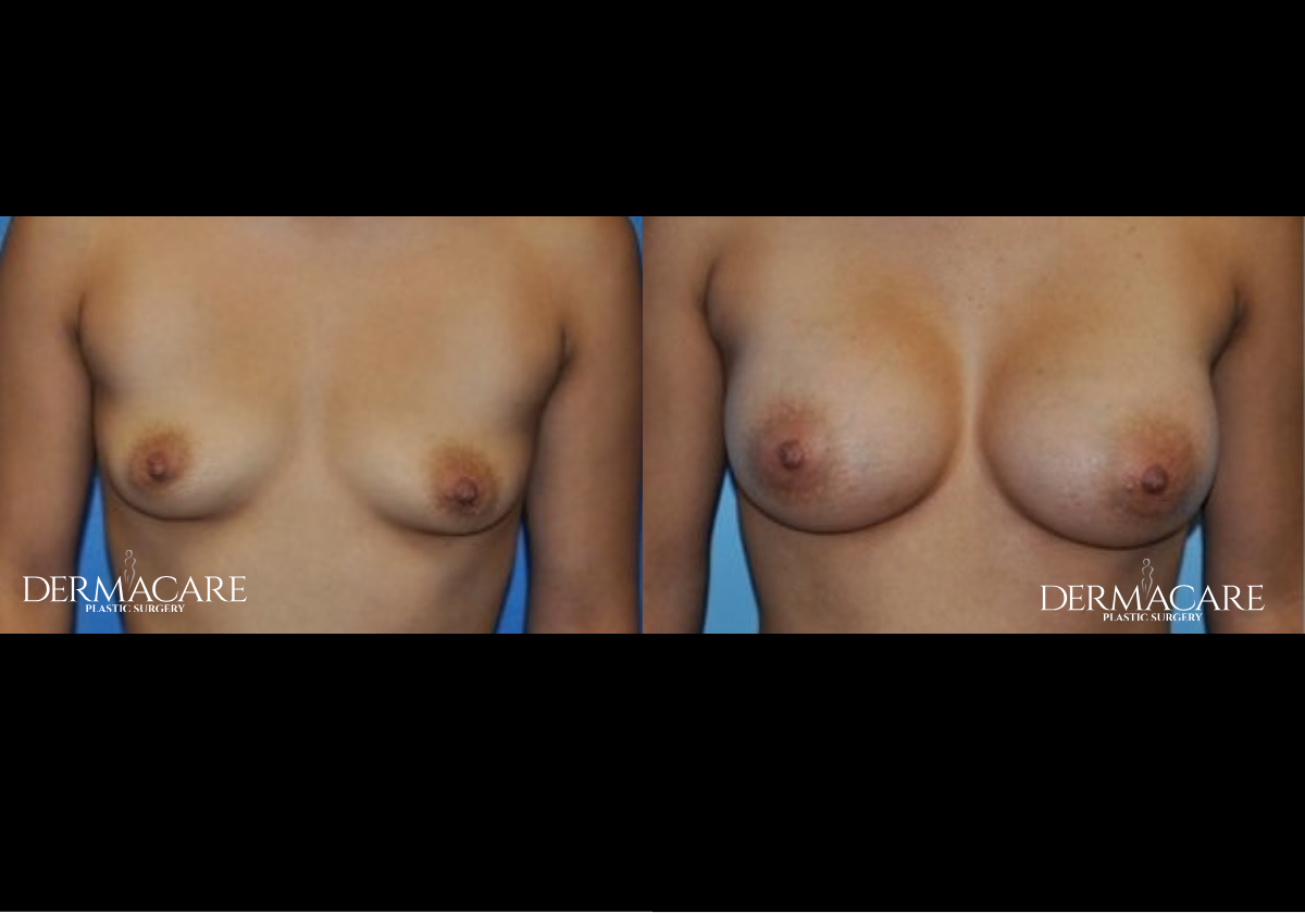 Breast Augmentation Before & Afters