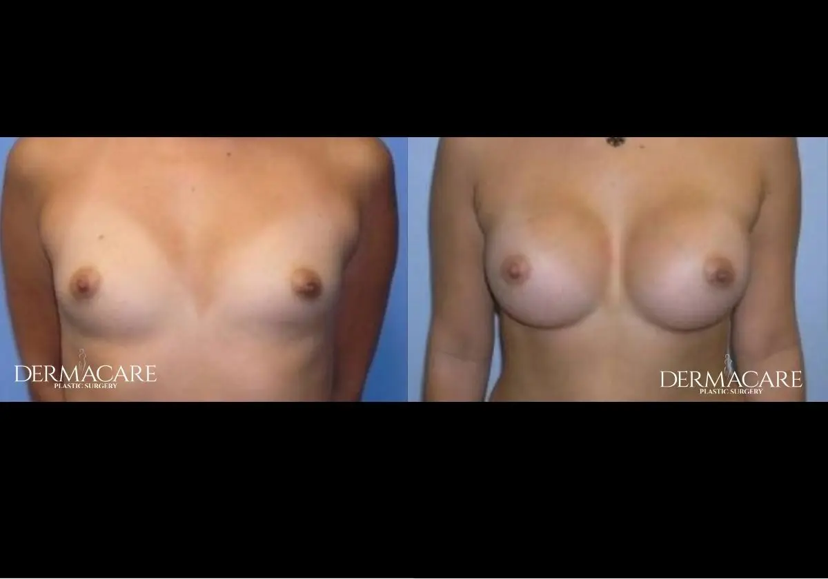 Breast Augmentation Before After