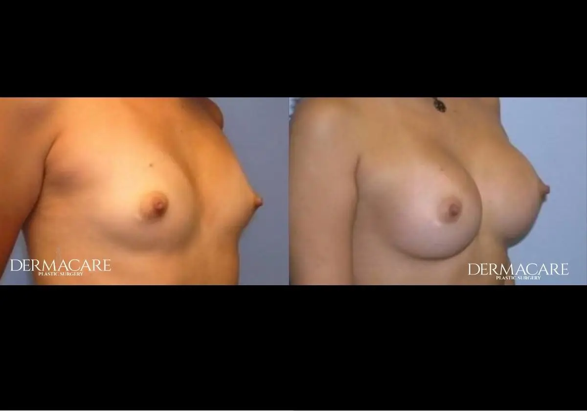 Breast Augmentation Before After