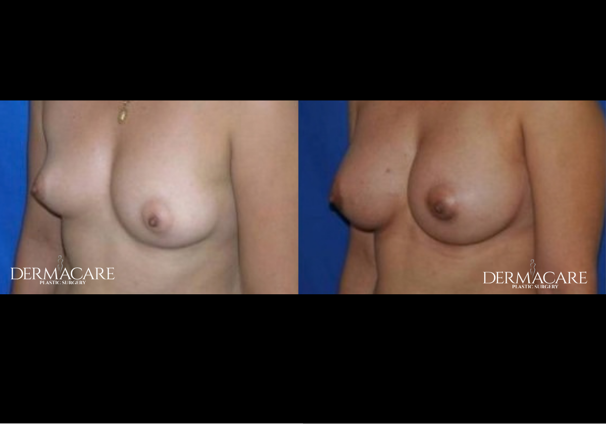 Breast Augmentation Before After