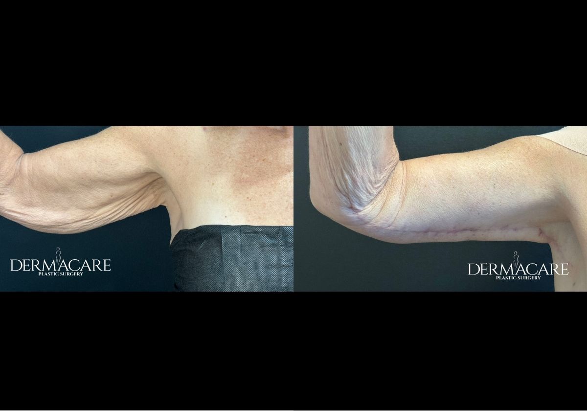 Arm Lift Before and Afters