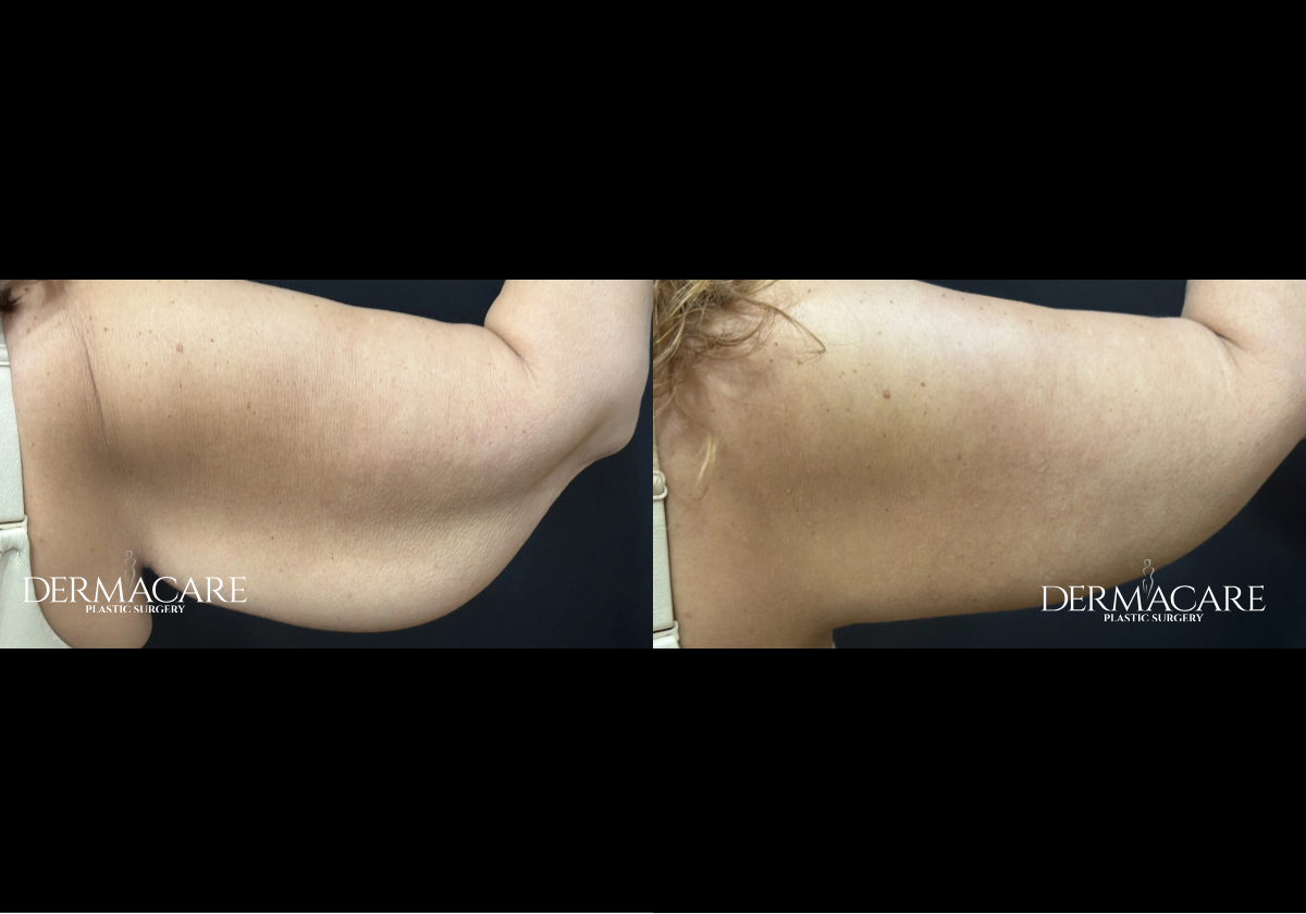 Arm Lift Before and Afters