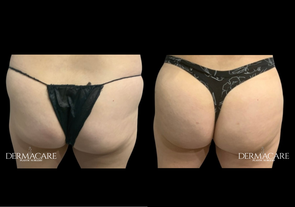 Brazilian Butt Lift Before & After