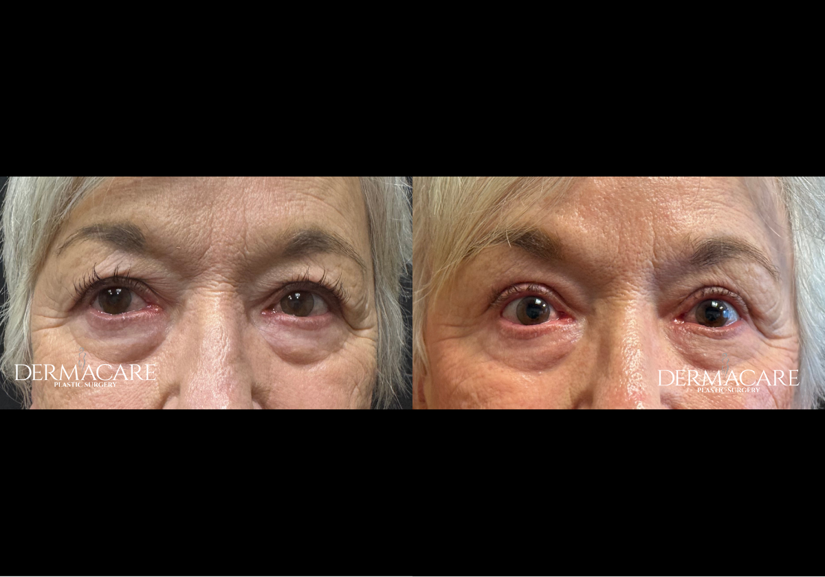 Eyelid Before & Afters