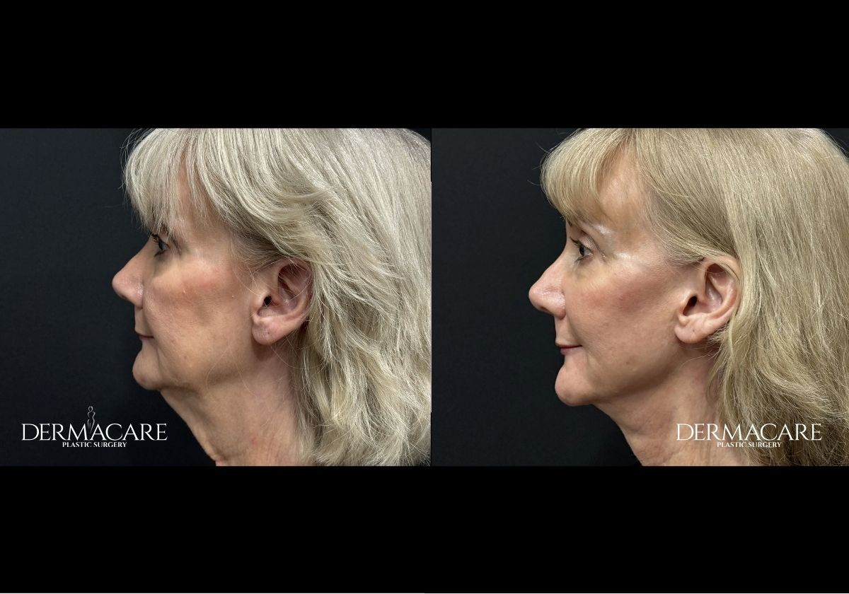 Facelift before after