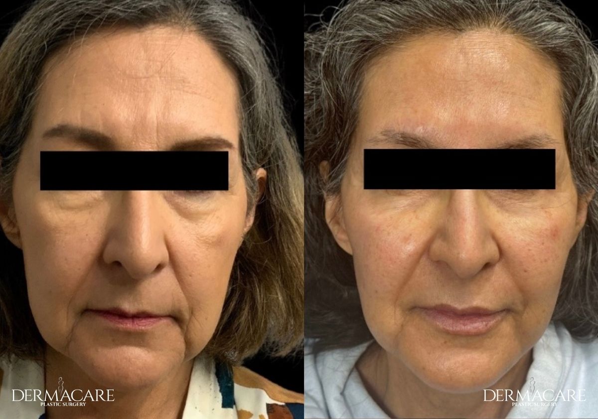 Facelift before after