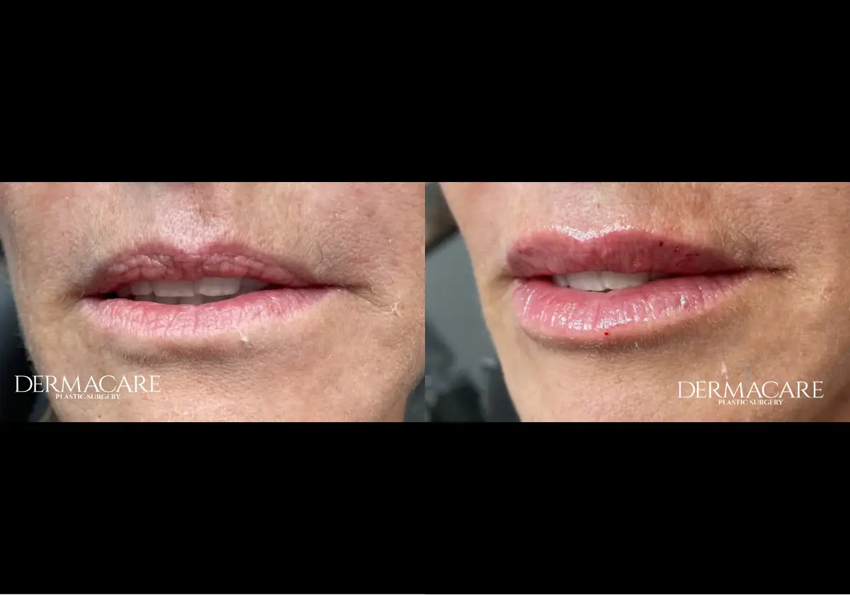 Lip Augmentation Before & After