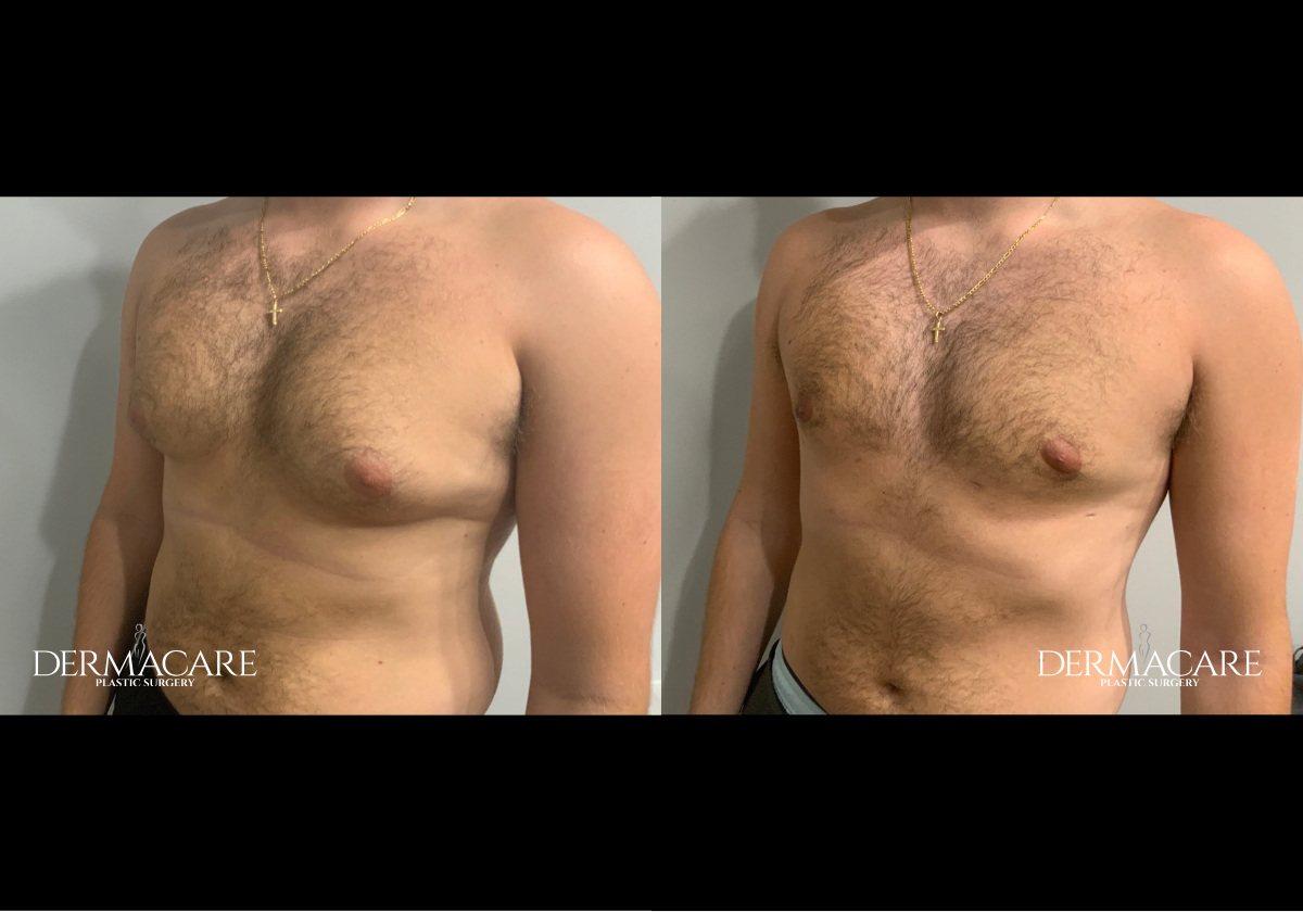 Male Patients Before Afters